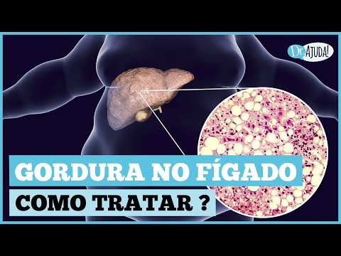 Como eliminar gordura no fígado rapidamente?