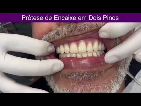 Como funciona a prótese dentária removível com encaixe?