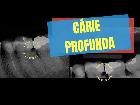 Como identificar um dente com cárie profunda?