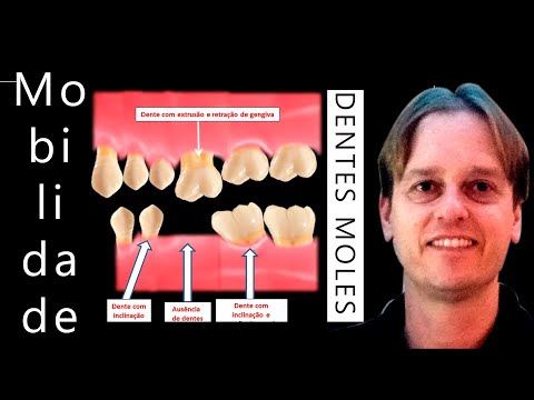 Como tratar dentes moles com remédios caseiros?