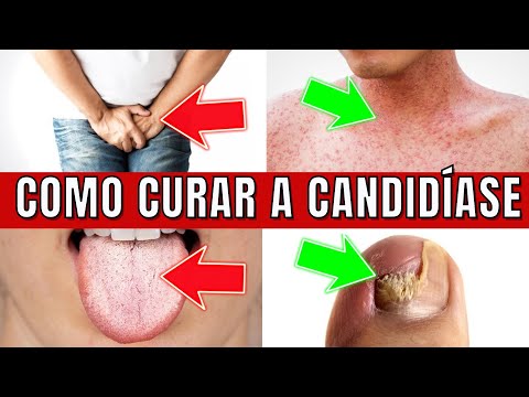 Como um banho de assento pode ajudar no tratamento da candidíase?