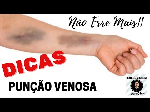 O que causa uma veia estourada no braço?