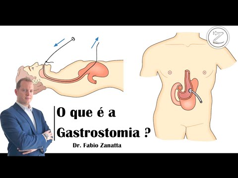 O que é gastrostomia?