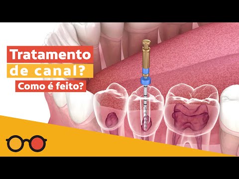 O tratamento de canal dói mesmo?