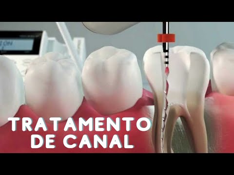 Pino no dente depois do canal: o que você precisa saber?