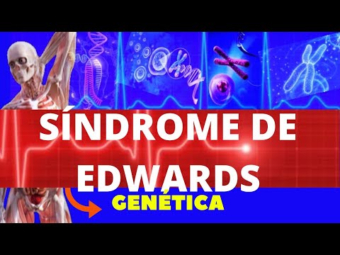 Quais são as características da síndrome de Edwards?