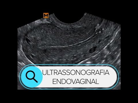 Qual é a importância do laudo de ultrassom de 5 semanas?