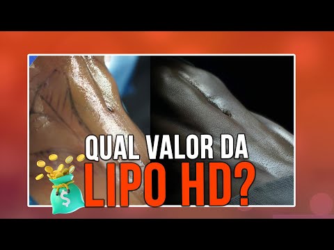 Qual é o preço da lipo LAD na JK Estética?