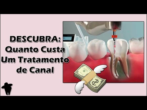 Quanto custa um canal no dente?