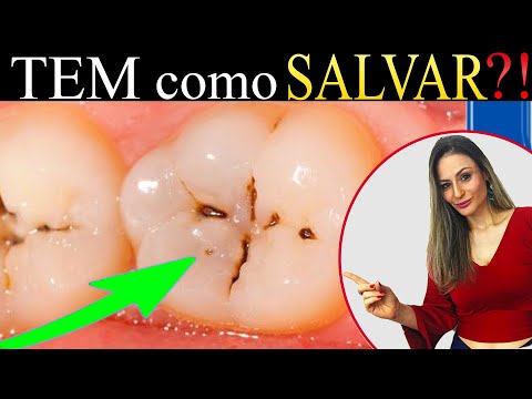 Quanto Tempo a Cárie Demora para Destruir o Dente?