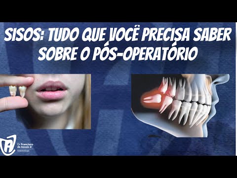 Quantos dias deve-se esperar para ter relação após extrair o dente siso?